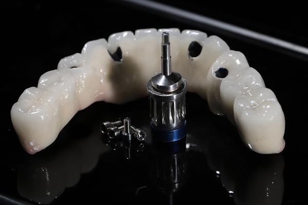 Essential Things To Know About All On   Dental Implants