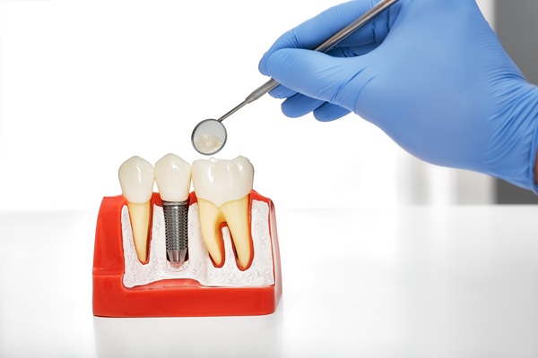 Tips For Implant Crown Care