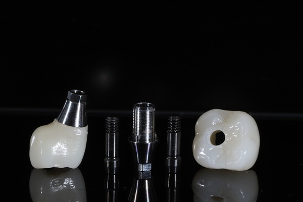 Reasons To Choose A Single Tooth Implant Over A Dental Bridge