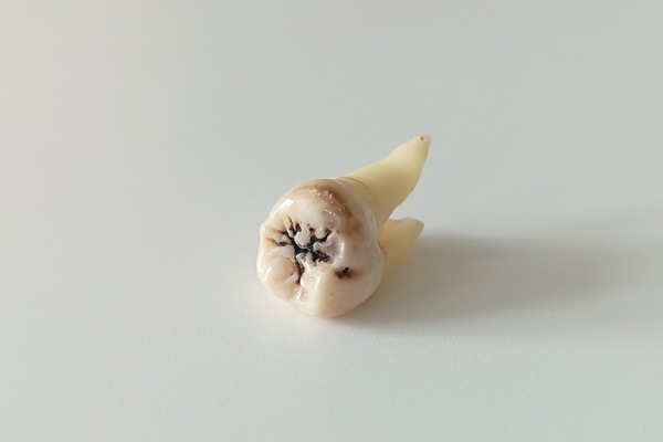 Life After A Tooth Extraction: How To Reduce The Risk Of Dry Socket